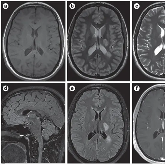 A Complete Guide To Head MRI Scan : From Indications To Completion